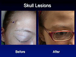 skull_lesions
