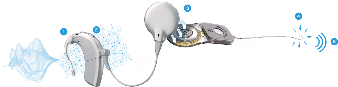 Diagram showing how a cochlear implant works, from external sound processor to the hearing nerve