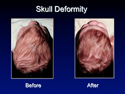 skull_deformity
